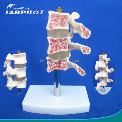 Geavanceerde PVC-educatieve modellen Cutaway Osteoporose van de wervelkolom Lezingen van de lumbale wervel