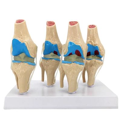 Anatomische demonstratie van het patologisch model van de menselijke knie voor de medische wetenschap