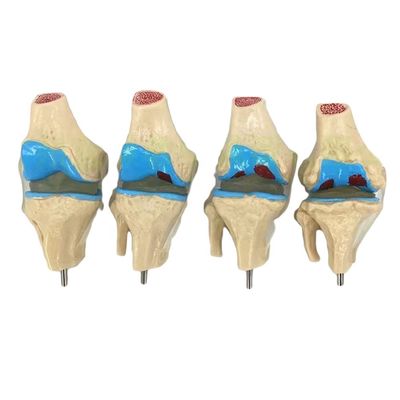 Anatomische demonstratie van het patologisch model van de menselijke knie voor de medische wetenschap