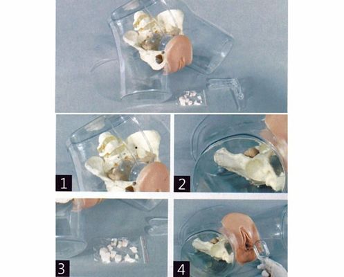 Verloskunde-Gynecologie Model Transparante Uterine Curettage Simulator voor Verpleegkundige School